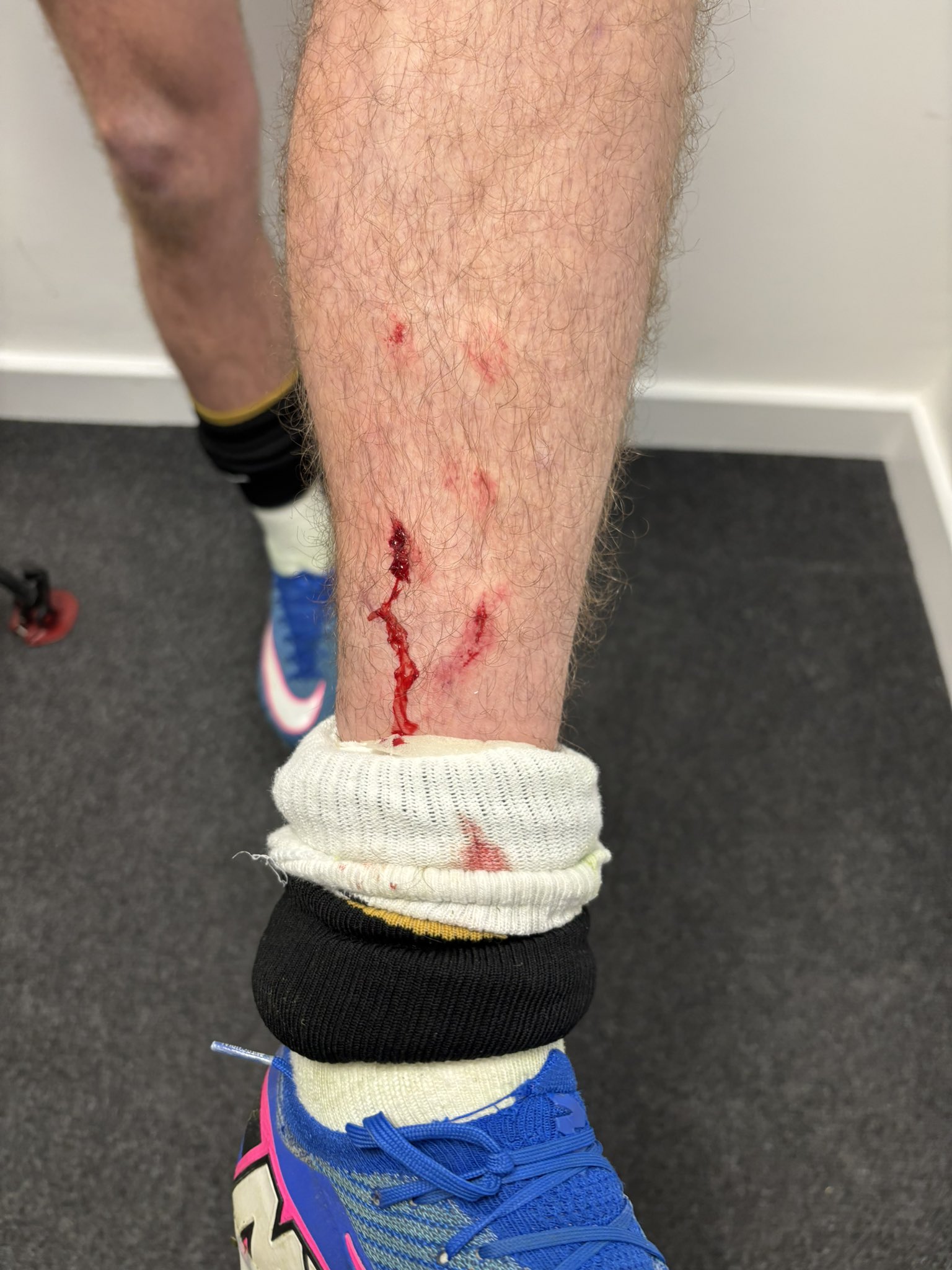 ‘Chunk of Flesh’ – Brooks’ Tiny Shin Graze Sparks Chaos – Cherries Fume Over Tanaka Tackle as Leeds Fans Fire Back